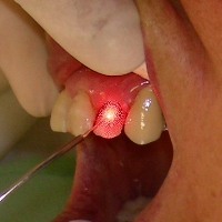 Laser dentale